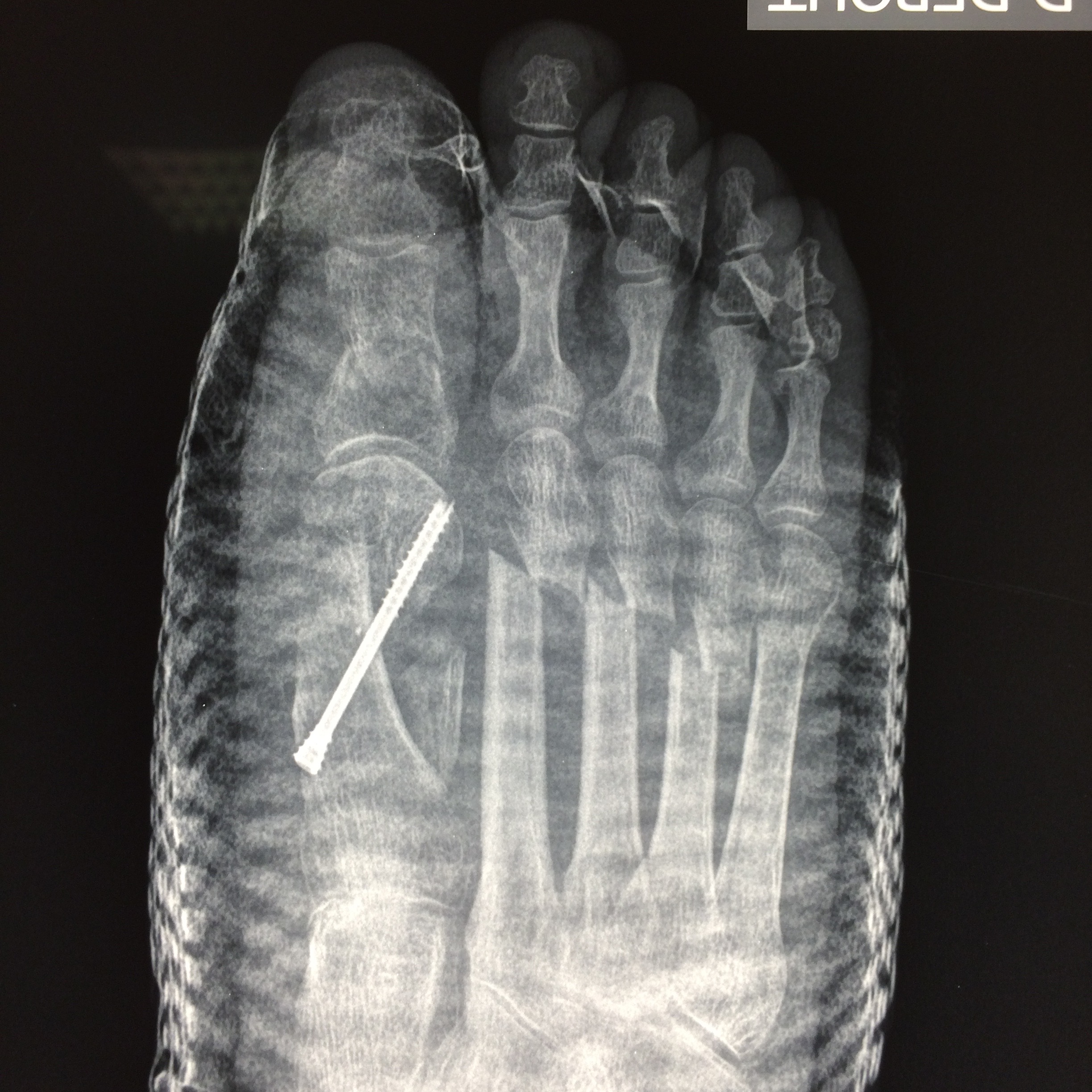 Pied Engourdi Apres Operation Hallux Valgus Pied Engourdi Apres Operation Hallux Valgus - Communauté MCMS