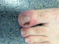 ongle incarné Dr PERRIER Cyril Dr LOPES Ronny Centre PCNA  Pied et Cheville Nantes Atlantique