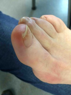 Exostose sous unguéale de l'hallux Dr PERRIER Cyril Dr LOPES Ronny PCNA Pied et Cheville Nantes Atlantique