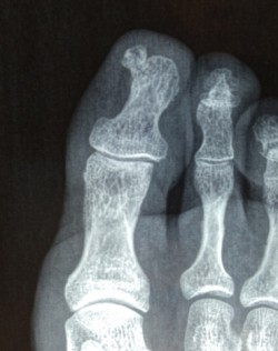 Exostose sous unguéale de l'hallux: Dr PERRIER Cyril Dr LOPES Ronny PCNA Pied et Cheville Nantes Atlantique