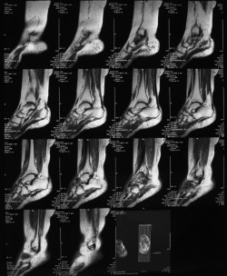 Arthrose de cheville: IRM Dr PERRIER Cyril Dr LOPES Ronny Centre PCNA Pied et Cheville Nantes Atlantique