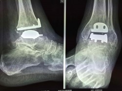 Prothèse de cheville sur bilan radiologique pour arthrose de cheville Dr PERRIER Cyril Dr LOPES Ronny Centre PCNA  Pied et Cheville Nantes Atlantique