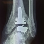 descellement  d'une prothèse cheville mise en place pour arthrose de cheville