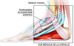 Tendinopathie tibiale postérieure