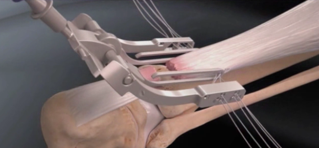 Réparation mini-invasive du tendon d'Achille | PCNA : Pied ...