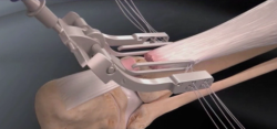 Réparation mini-invasive du tendon d'Achille